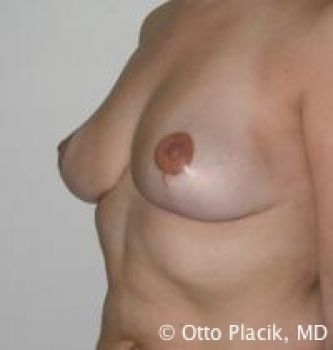 Breast Reduction Chicago