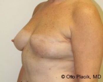 Breast Augmentation with Fat Grafting Chicago