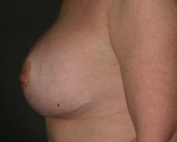 Nipple Repair - Before & After - Dr. Placik