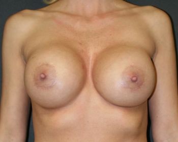 Breast Implant Exchange - Before & After - Dr. Placik