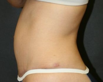 Tummy Tuck - Before & After - Dr. Placik