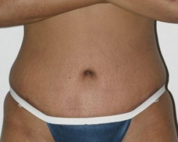 Tummy Tuck Chicago