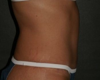 Tummy Tuck Chicago