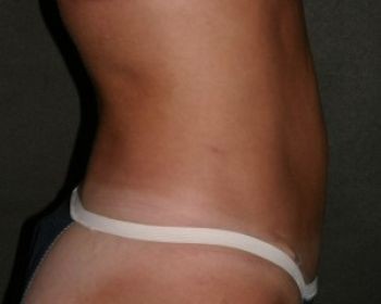 Tummy Tuck Chicago