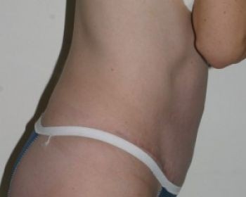 Tummy Tuck Chicago