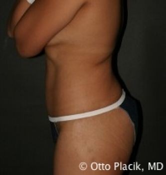 Tummy Tuck Chicago