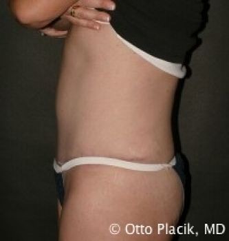 Tummy Tuck Chicago