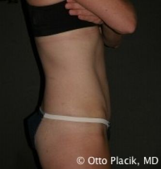 Tummy Tuck Chicago