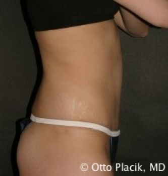 Tummy Tuck Chicago