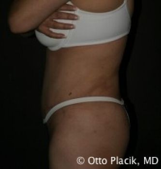 Tummy Tuck Chicago