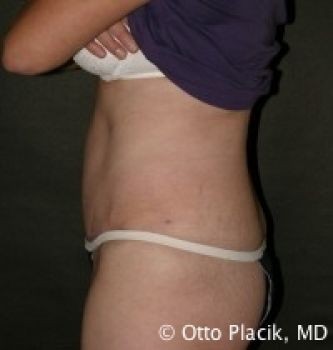 Tummy Tuck Chicago