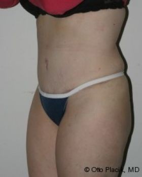 Tummy Tuck - Before & After - Dr. Placik