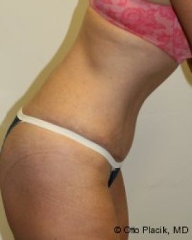 Tummy Tuck Chicago