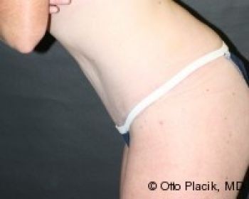 Tummy Tuck - Before & After - Dr. Placik