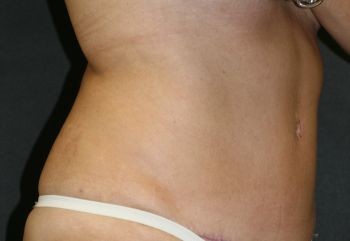 Tummy Tuck Chicago