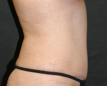 Tummy Tuck