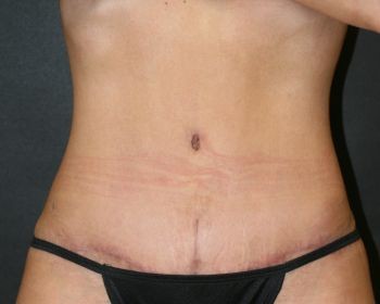 Tummy Tuck - Before & After - Dr. Placik