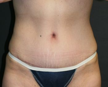 Tummy Tuck - Before & After - Dr. Placik