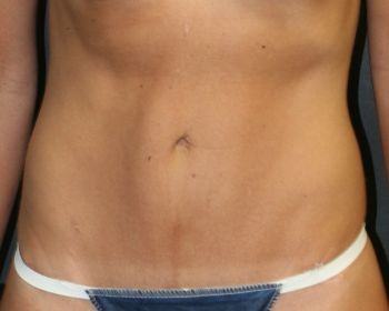 Tummy Tuck - Before & After - Dr. Placik