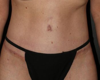 Tummy Tuck - Before & After - Dr. Placik