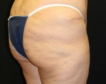 Liposuction Chicago