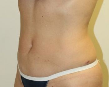 Liposuction Chicago