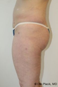 Liposuction Chicago