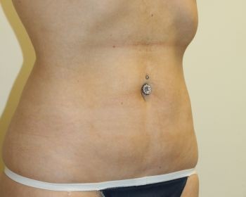 Liposuction Chicago