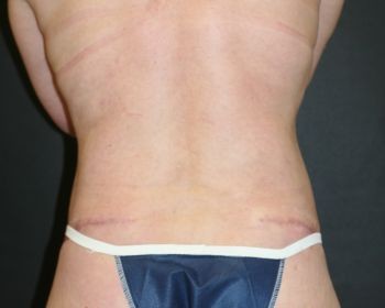 Liposuction - Before & After - Dr. Placik
