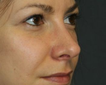 Rhinoplasty Chicago