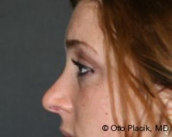 Rhinoplasty - Before & After - Dr. Placik