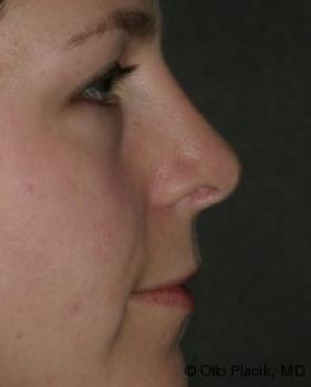 Rhinoplasty - Before & After - Dr. Placik