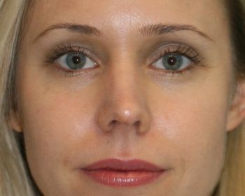 Rhinoplasty Chicago