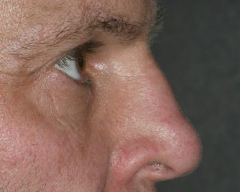 Non-Surgical Rhinoplasty - Before & After - Dr. Placik