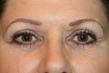 Eyelid Surgery - Before & After - Dr. Placik