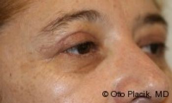 Eyelid Surgery - Before & After - Dr. Placik