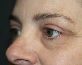 Eyelid Surgery - Before & After - Dr. Placik