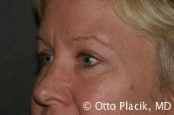 Eyelid Surgery - Before & After - Dr. Placik