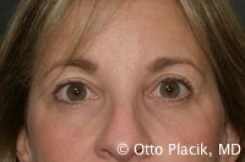 Eyelid Surgery - Before & After - Dr. Placik