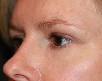 Eyelid Surgery - Before & After - Dr. Placik