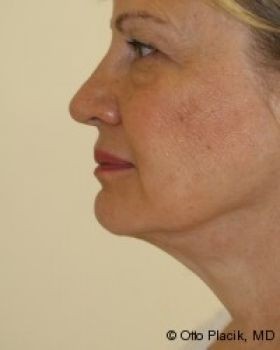 Neck Lift - Before & After - Dr. Placik