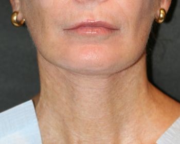 Neck Lift - Before & After - Dr. Placik