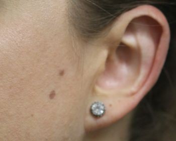 Ear Surgery - Before & After - Dr. Placik