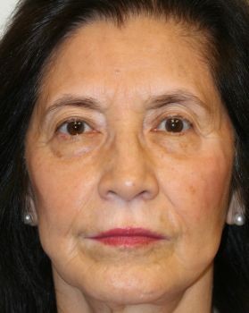 Multiple Facial Procedures - Before & After - Dr. Placik