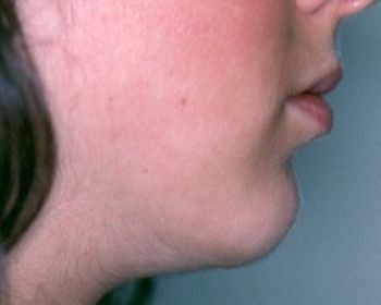 Chin Surgery - Before & After - Dr. Placik