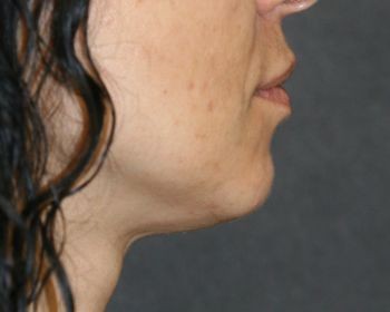 Kybella - Before & After - Dr. Placik