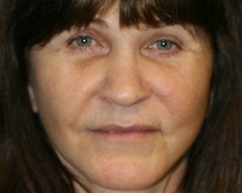 Lipoinjections to Various Facial Areas - Before & After - Dr. Placik