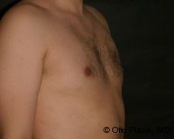 Male Breast Reduction - Before & After - Dr. Placik