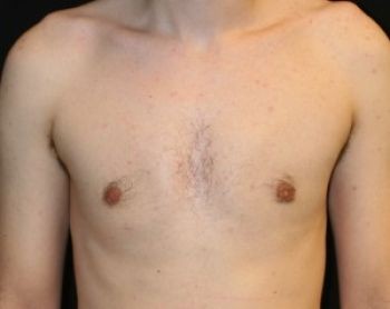 Male Breast Reduction - Before & After - Dr. Placik