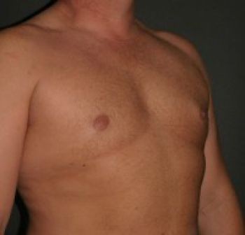 Male Breast Reduction - Before & After - Dr. Placik